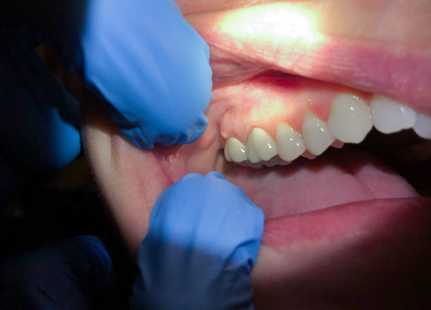 Best Dentist for Tooth Abscess  in The Galena Territory, IL